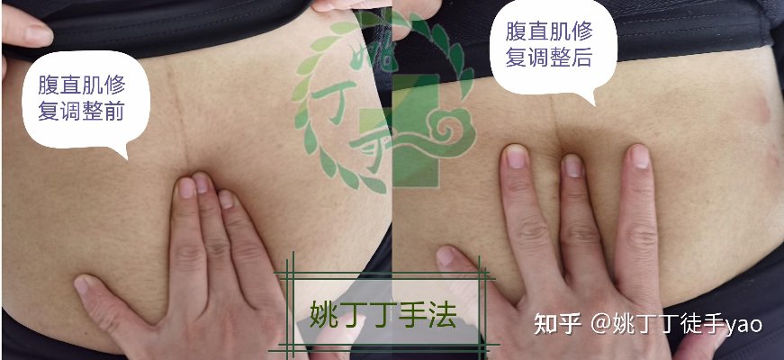 腹直肌分离修复